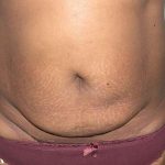 Tummy Tuck Before & After Patient #3057