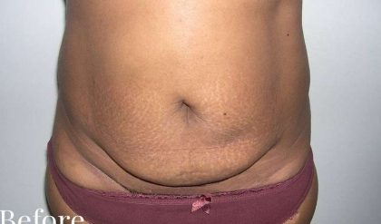 Tummy Tuck Before & After Patient #3057