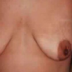 Breast Lift Before & After Patient #2273
