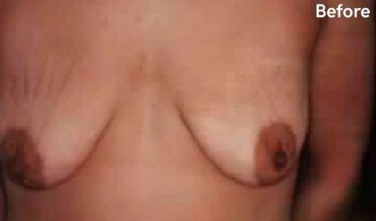 Breast Lift Before & After Patient #2273