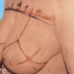 Breast Reduction Before & After Patient #2357
