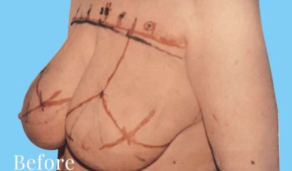 Breast Reduction Before & After Patient #2357