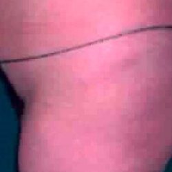 Buttock Augmentation Before & After Patient #2405