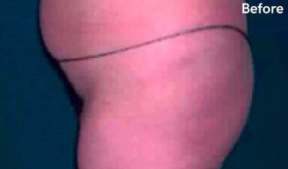 Buttock Augmentation Before & After Patient #2405