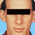 Otoplasty Male Before & After Patient #2538