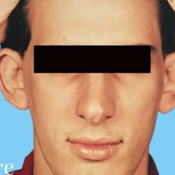 Otoplasty Male Before & After Patient #2538
