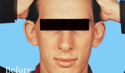 Otoplasty Male Before & After Patient #2538