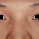 Eyelid Surgery Before & After Patient #2611