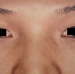 Eyelid Surgery Before & After Patient #2611