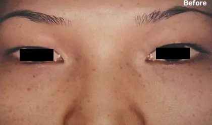 Eyelid Surgery Before & After Patient #2611