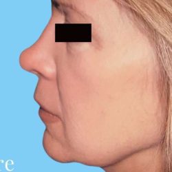Facelift Before & After Patient #2647