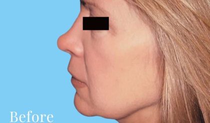 Facelift Before & After Patient #2647