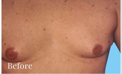 Daddy Makeover Before & After Patient #2511
