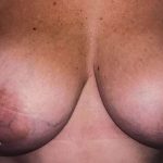 Breast Augmentation Before & After Patient #2219