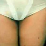 Liposuction Before & After Patient #2841