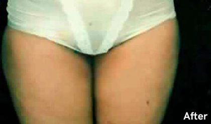 Liposuction Before & After Patient #2841