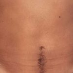 Liposuction Male Before & After Patient #2900