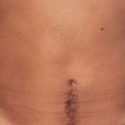 Liposuction Male Before & After Patient #2900