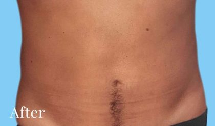 Liposuction Male Before & After Patient #2900