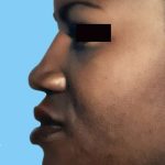 Rhinoplasty Before & After Patient #2973
