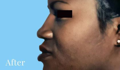 Rhinoplasty Before & After Patient #2973