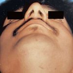Rhinoplasty Male Before & After Patient #3018