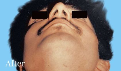 Rhinoplasty Male Before & After Patient #3018