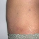 Tummy Tuck Before & After Patient #3060