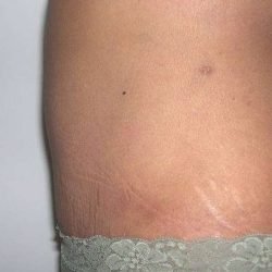 Tummy Tuck Before & After Patient #3060