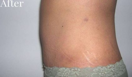Tummy Tuck Before & After Patient #3060