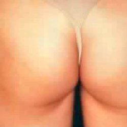 Buttock Augmentation Before & After Patient #2411
