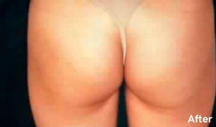 Buttock Augmentation Before & After Patient #2411