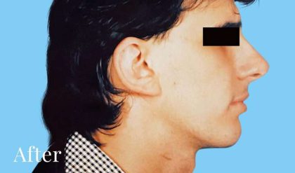 Otoplasty Male Before & After Patient #2538