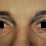 Eyelid Surgery Before & After Patient #2614