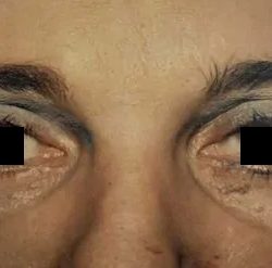 Eyelid Surgery Before & After Patient #2614