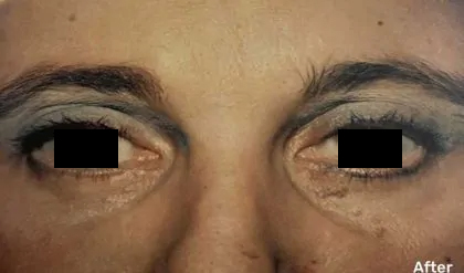 Eyelid Surgery Before & After Patient #2614