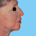 Facelift Before & After Patient #2650