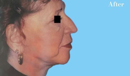 Facelift Before & After Patient #2650