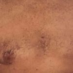 Gynecomastia Before & After Patient #2713