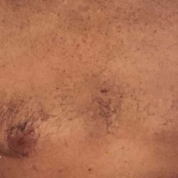 Gynecomastia Before & After Patient #2713
