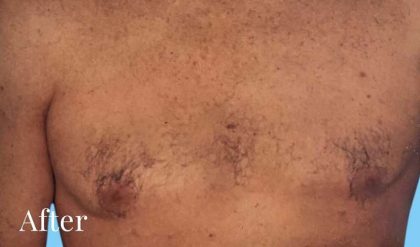 Gynecomastia Before & After Patient #2713