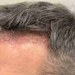 Hair Restoration Before & After Patient #2760