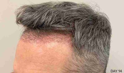 Hair Restoration Before & After Patient #2760