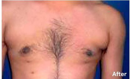 Daddy Makeover Before & After Patient #2516