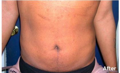 Daddy Makeover Before & After Patient #2516