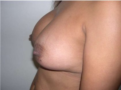 Breast Lift Before & After Patient #2278
