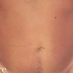 Liposuction Male Before & After Patient #2900
