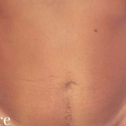 Liposuction Male Before & After Patient #2900
