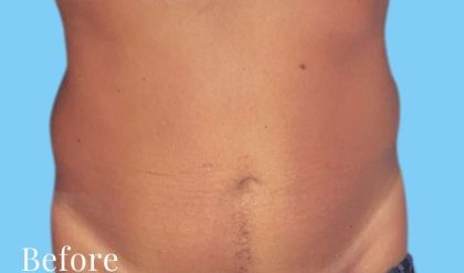 Liposuction Male Before & After Patient #2900