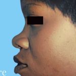 Rhinoplasty Before & After Patient #2973